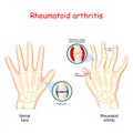 Rheumatoid Arthritis. Healthy hand, and hand with rheumatoid arthritis