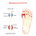 Rheumatoid arthritis in joints of human`s foot
