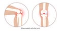 Arthritis in knee joint Royalty Free Stock Photo