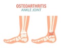 Rheumatoid arthritis. Osteoarthritis of the human ankle joints. Medical concept. Infographic poster, banner