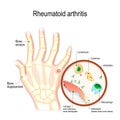 Rheumatoid Arthritis RA is an auto immune disease and inflammatory type of arthritis