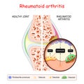 Rheumatoid arthritis Royalty Free Stock Photo