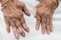 Rheumatoid Arthritis, Senior Hands