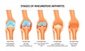Rheumatoid Arthritis Stages Infographics Royalty Free Stock Photo
