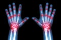 Rheumatoid arthritis ( X-ray both child hands and multiple joint arthritis )