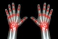 Rheumatoid arthritis ( X-ray both child hands and multiple joint arthritis ) Royalty Free Stock Photo