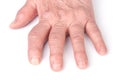 Rheumatoid polyarthritis of hands isolated on white background Royalty Free Stock Photo