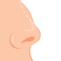 Rhinoplasty color icon. Nose reshaping Facial rejuvenation. Hump