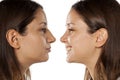 Rhinoplasty