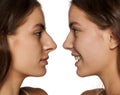 Rhinoplasty