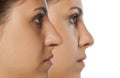 rhinoplasty