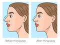 rhinoplasty for nose correction schematic