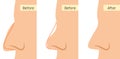 Rhinoplasty nose plastic surgery icon. Vector rhinoplasty beauty face icon surgery