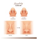 Rhinoplasty. Open and closed rhinoplasty. Side and bottom view. Plastic surgery nose. For Medical and beauty designs