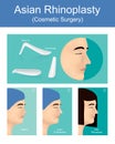 Rhinoplasty is a plastic surgery creates a aesthetic and facial
