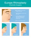 Rhinoplasty plastic surgery.