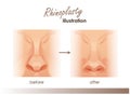 Rhinoplasty. Plastic surgery nose. Front view of a human nose. Before and after illustrations Royalty Free Stock Photo