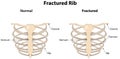 Rib Cage with a Fracture