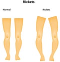 Rickets Royalty Free Stock Photo