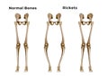 Rickets is a metabolic disease characterized by deformities of the bones. The most common symptoms are bowed legs