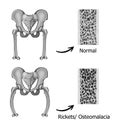 Rickets-osteomalacia Royalty Free Stock Photo