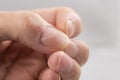 Ridged fingernails with vertical and horizontal ridges. Nails problems Royalty Free Stock Photo