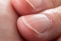 Ridged fingernails with vertical ridges.Nails problems Royalty Free Stock Photo