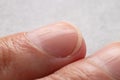 Ridged fingernails with vertical ridges.Nails problems Royalty Free Stock Photo