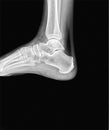 Right ankle x-ray. Side scan