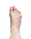 Right bunion - hallux valgus on white background and clipping pa