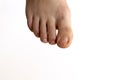 right foot close-up on a white background. Diseases of the nails and bones,