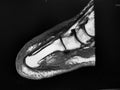Right foot MRI, prior first toe amputation