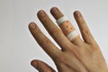 Right hand with a splint on the ring finger Royalty Free Stock Photo