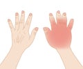 Right-hand swollen infection sting allergy injury in comparison to the normal left hand, illustration on white background