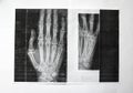 Right hand x ray image Royalty Free Stock Photo