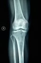 Right knee joint X-ray photograph Royalty Free Stock Photo