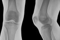 Right knee x-ray. Royalty Free Stock Photo