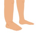 Right leg swollen infection allergy injury in comparison to the normal left leg, illustration on white background
