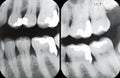 Right Periodontal X-rays Royalty Free Stock Photo