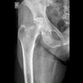 Hip joint x-ray image AP view