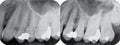 Right Upper Periodontal X-rays