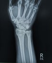 Right Wrist and hand x-ray PA view showing intra-articular comminuted fracture distal radius. Medical image concep
