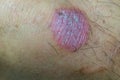 Ring Worm infection, Dermatophytosis on skin. Ringworm infection or Tinea on skin. Mycosis infection on the human skin. Royalty Free Stock Photo