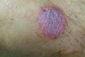 Ring Worm infection, Dermatophytosis on skin. Ringworm infection or Tinea on skin. Mycosis infection on the human skin. Royalty Free Stock Photo