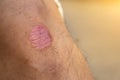 Ring Worm infection, Dermatophytosis on skin. Ringworm infection or Tinea on skin. Mycosis infection on the human skin. Royalty Free Stock Photo