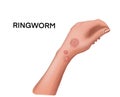 Ringworm on the hand Royalty Free Stock Photo