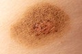 Ringworm on the human skin as a background