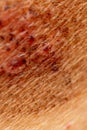 Ringworm on the human skin as a background