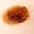 Ringworm on the human skin as a background