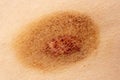 Ringworm on the human skin as a background